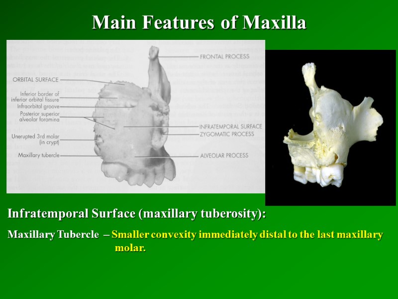 Main Features of Maxilla   Infratemporal Surface (maxillary tuberosity): Maxillary Tubercle  –